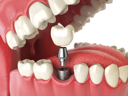 Tooth,Human,Implant.,Dental,Concept.,Human,Teeth,Or,Dentures.,3d