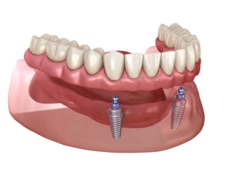 Mandibular,Removable,Prosthesis,All,On,2,System,Supported,By,Implants