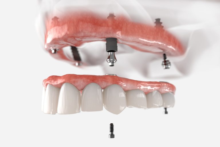 Maxillary,Fixed,Restoration,With,4,Implants.,Realistic,3d,Illustration.